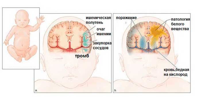 ишемия головного мозга у новорожденного