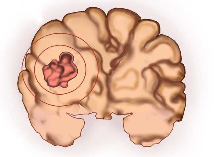 Астроцитома головного мозга