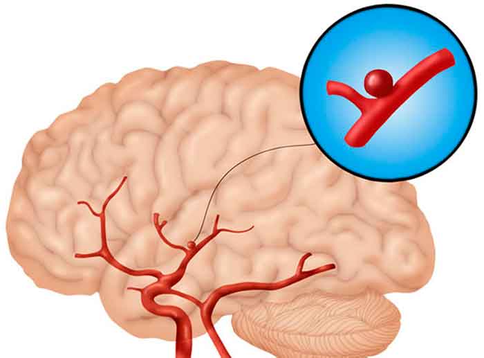 аневризма сосудов головного мозга