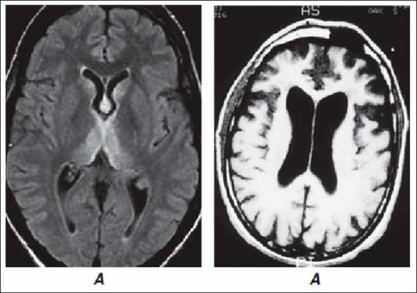 Энцефалопатия мозга последствия