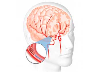 Энцефалопатия головного мозга лечение препараты