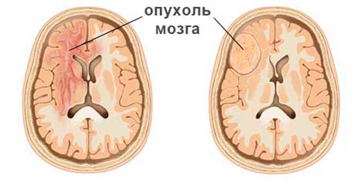 opuhol-mozga-543