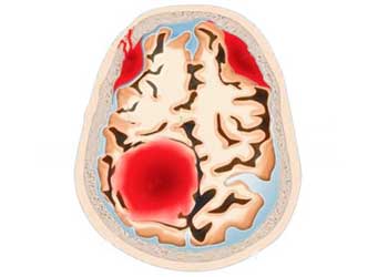 Кровоизлияние в мозг — Причины и методы лечения, первая помощь