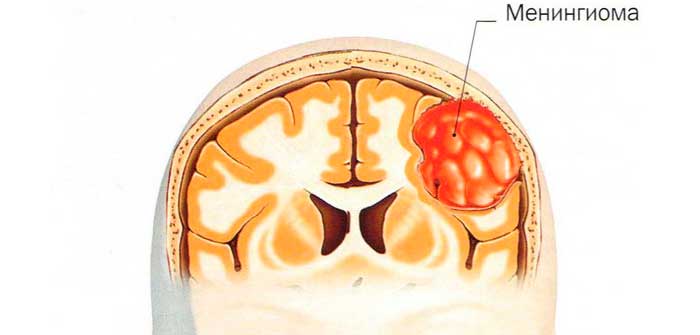 Изображение - Давление головы человека meningioma