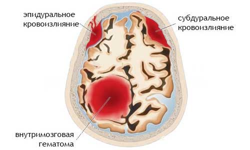 Мозговое кровоизлияние