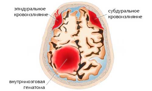 виды кровоизлияния в мозг