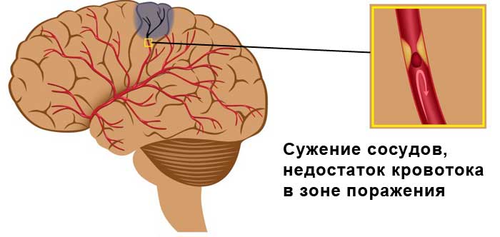 Ишемический инсульт головного мозга