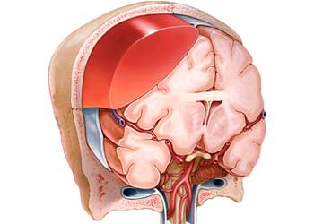 Размеры гематома головного мозга thumbnail