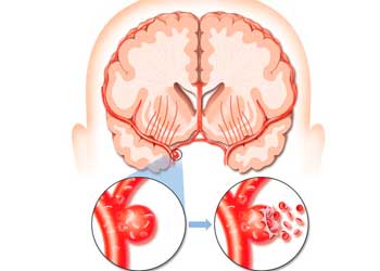 Аневризма сосудов головного мозга – симптомы и причины, варианты лечения, последствия разрыва и прогноз