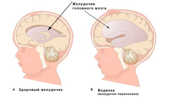 водянка головного мозга