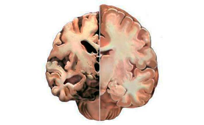 Очаговые изменения вещества головного мозга