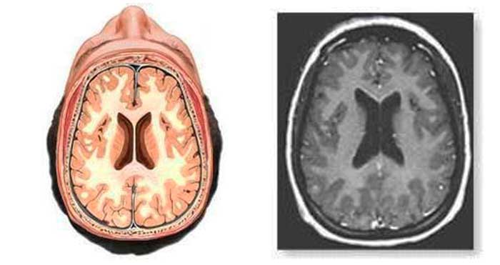 Томограмма головного мозга