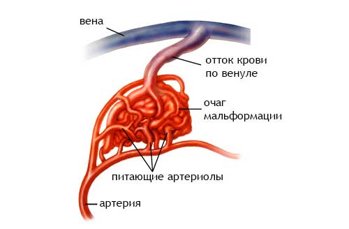 Артериовенозный шунт. Артериовенозная мальформация артерии. Артериовенозная мальформация классификация. Артерия венозная мальформация. Мальформация кишечника.