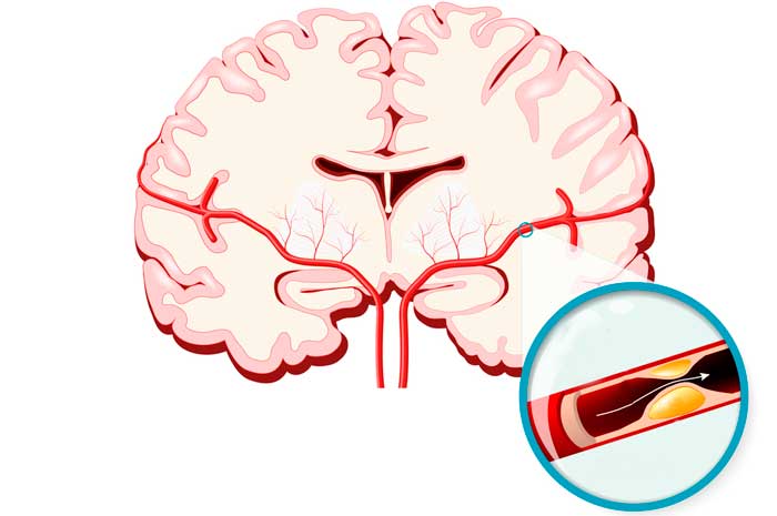 Атеросклероз сосудов головного мозга: симптомы, лечение