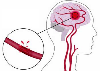 Разрыв кровеносных сосудов в мозге thumbnail