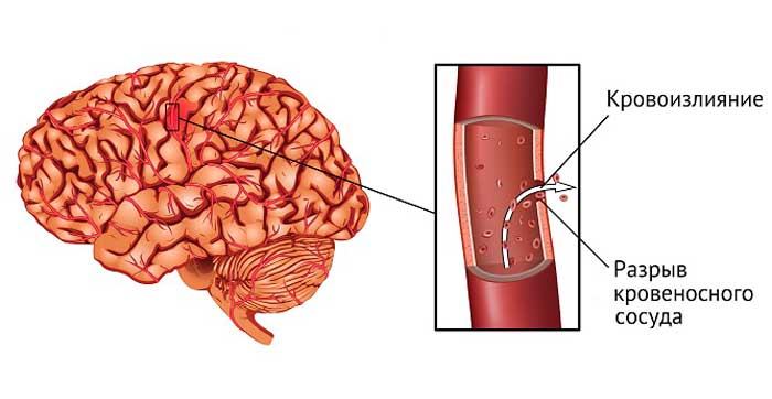 геморрагический инсульт головного мозга