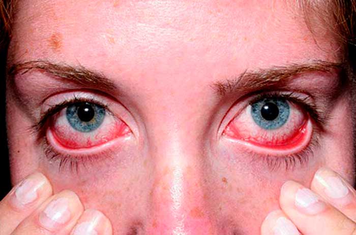 синдром сухого глаза