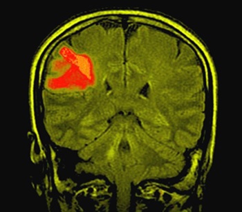 Астроцитома головного мозга