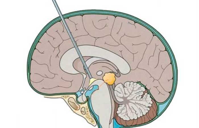 Шунтирование сосудов головного мозга после инсульта