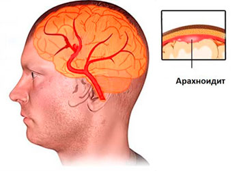 Арахноидит головного мозга: симптомы и последствия