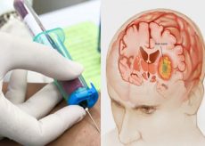 Анализ крови при раке головного мозга